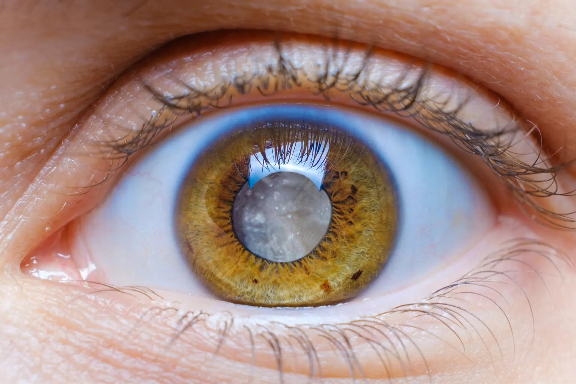 Ayurvedic ophthalmic science in Timira and Linganāśa: classical surgical insight and conservative management of senile cataract